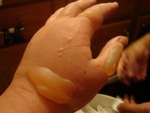 Swollen hand from burn | Colorado Timber Industry Association