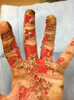 Badly burned hand | Colorado Timber Industry Association